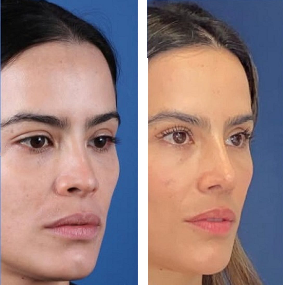 Rinoplastia caso 6 — antes y después